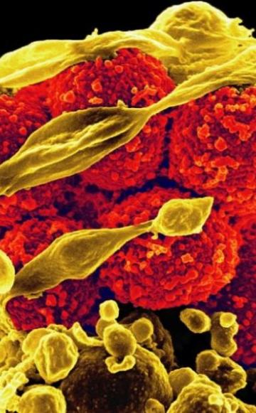 Scanning electron micrograph of methicillin-resistant Staphylococcus aureus bacteria (yellow, round items) killing and escaping from a human white cell. Photo: NIAID via Flickr (CC BY).