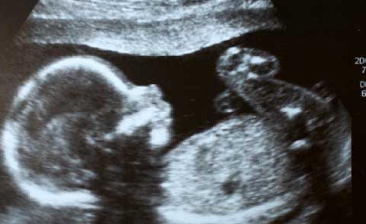 Air pollutants link to lower child IQ